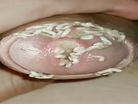 Larvae in the penis